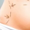 La chirurgie esthétique en dernier recours