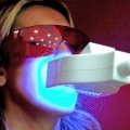 Le blanchiment des dents au laser