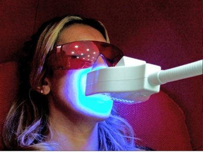 Le blanchiment des dents au laser